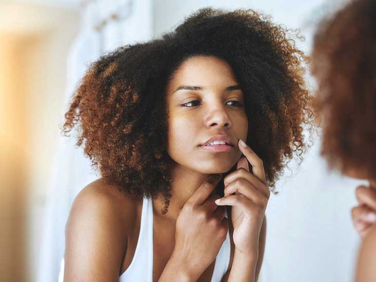 Why You’re Having Acne (Pimples, Blackheads, Whiteheads, etc.) and How to Stop It