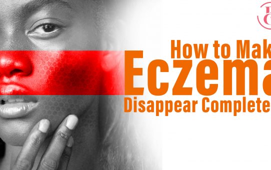 How to Make Eczema Disappear Completely