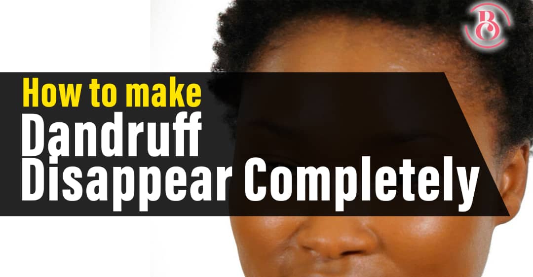 How to Make Dandruff Disappear Completely