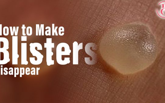 4 Sure Ways to Make Blisters Disappear