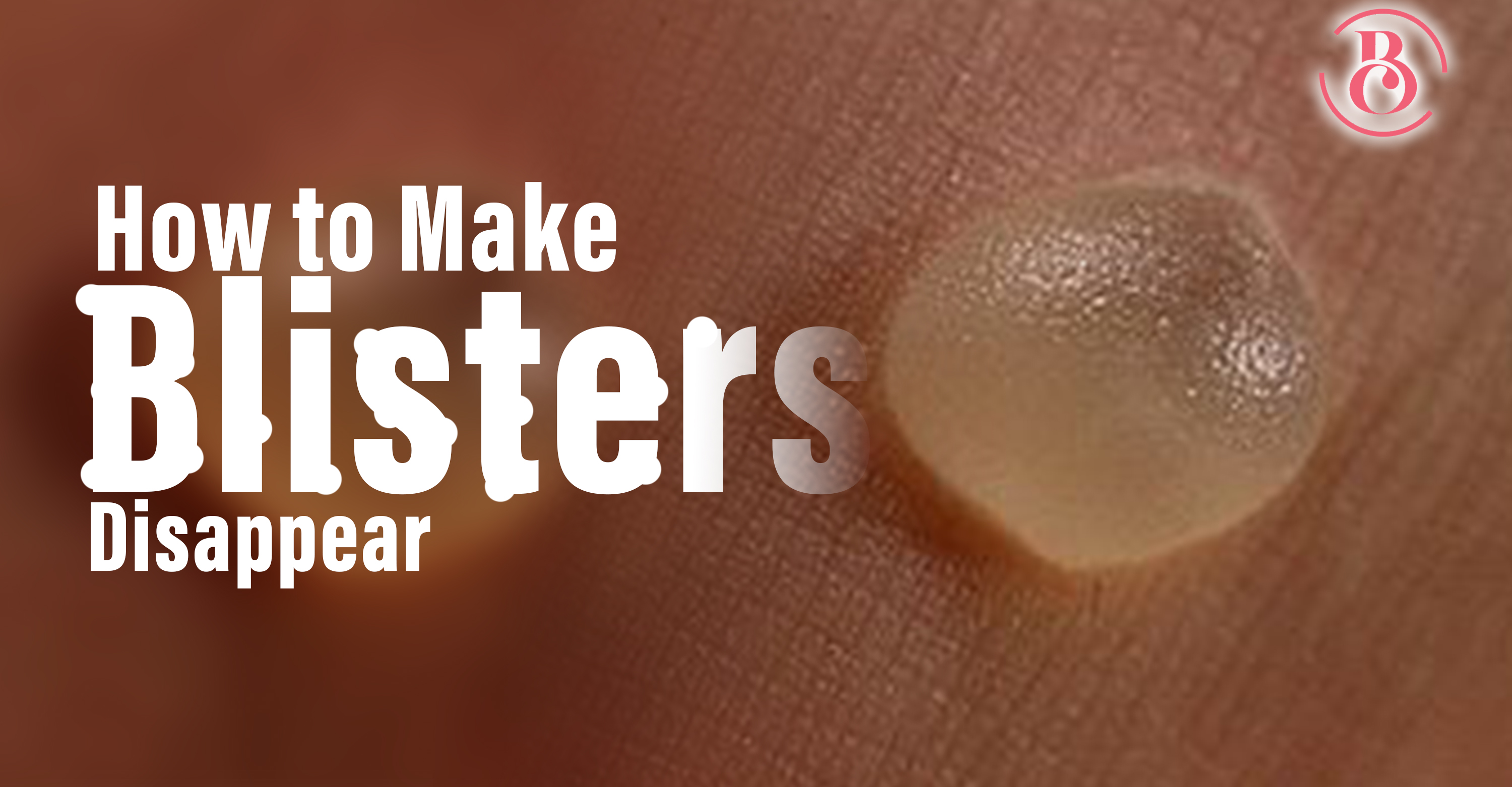 4 Sure Ways to Make Blisters Disappear