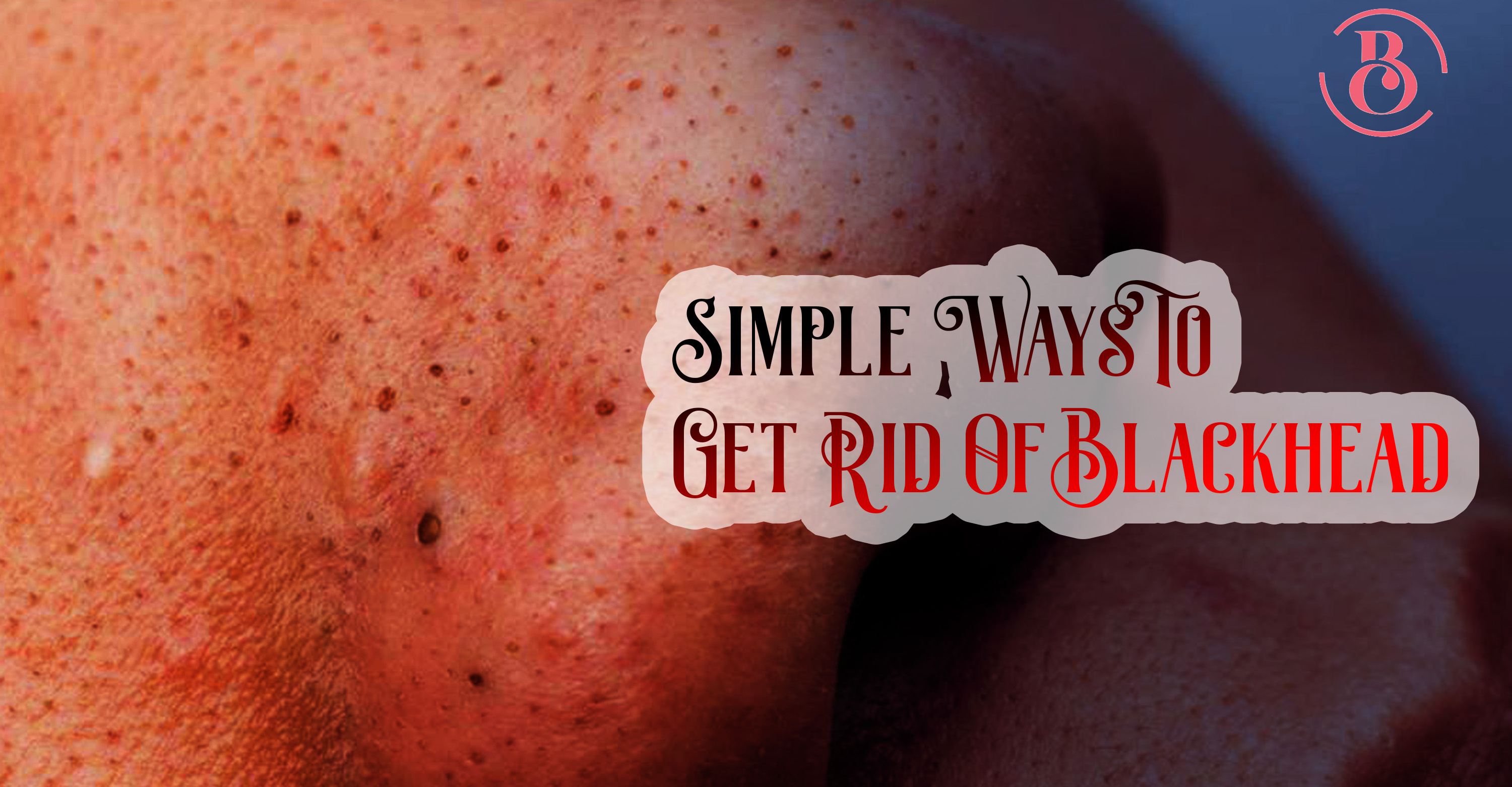 8 Simple Ways to Get Rid Of Blackheads