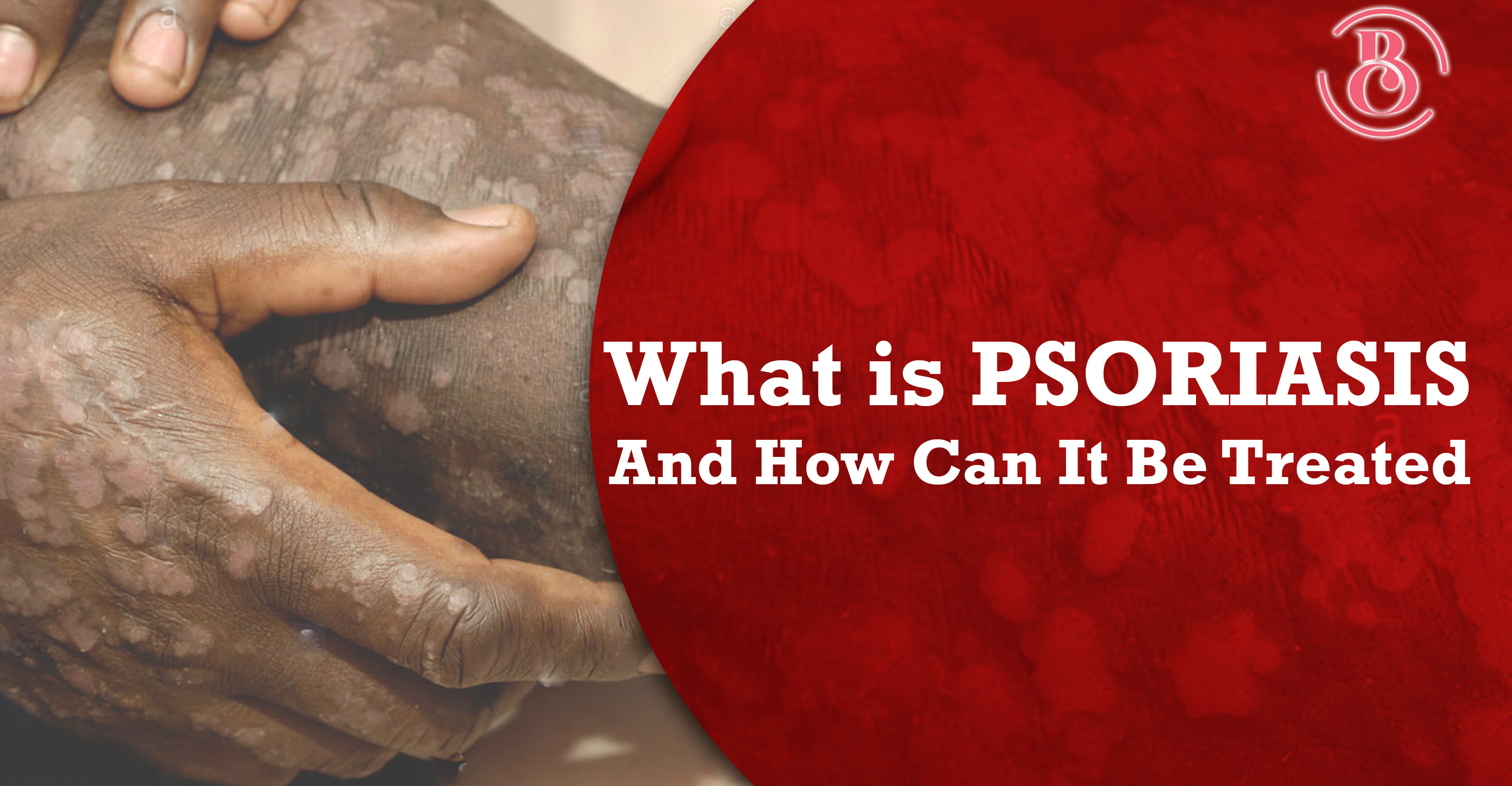 What Is Psoriasis and How Can It Be Treated?