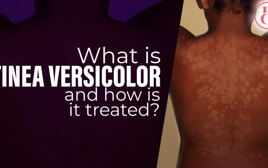 What is Tinea Versicolor and How is it Treated?