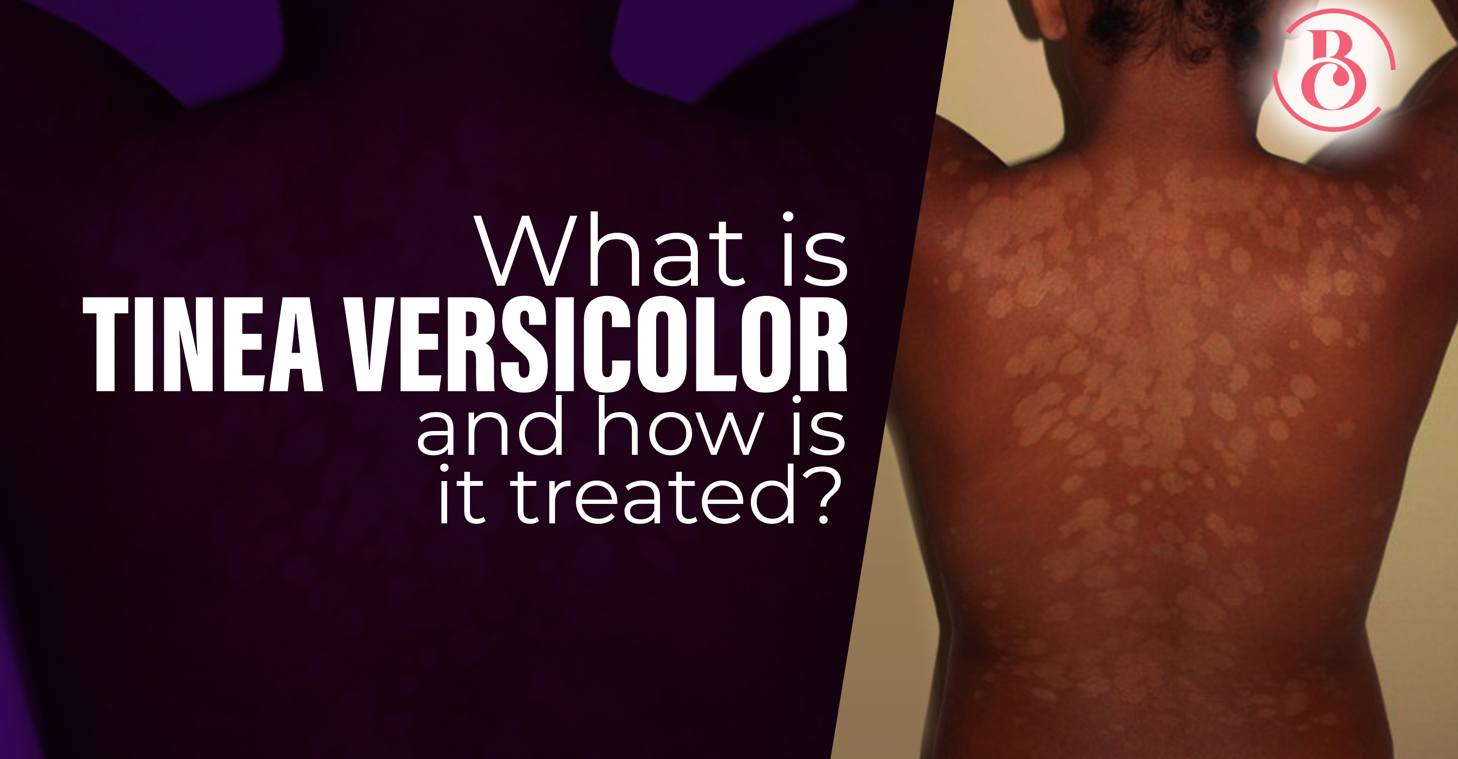 What is Tinea Versicolor and How is it Treated?