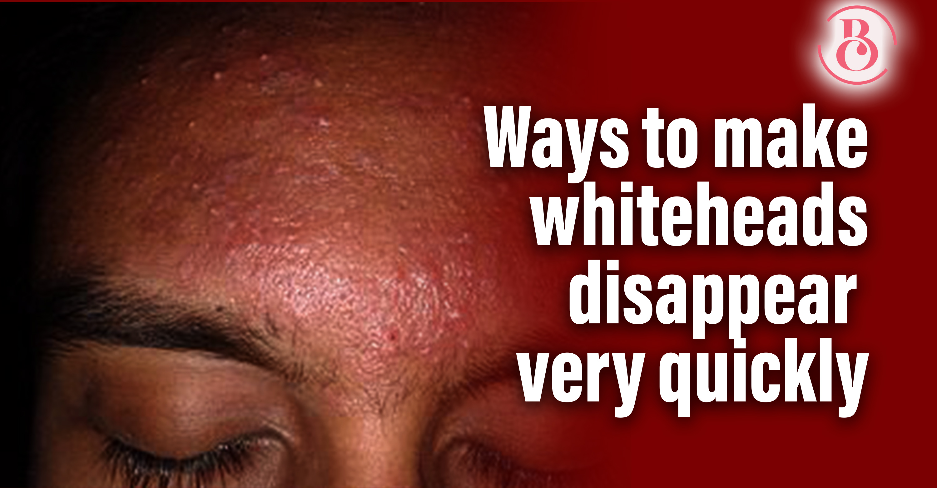 10 Ways to Make Whiteheads Disappear Very Quickly