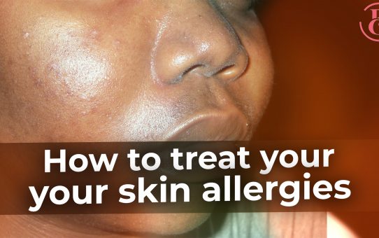 How To Treat Your Skin Allergies