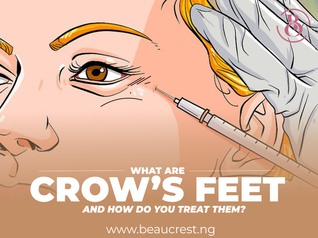 What Are Crow’s Feet and How Do You Treat them?