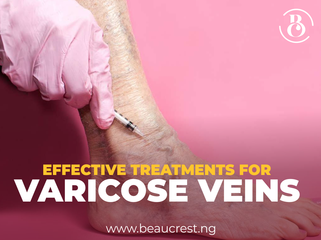 8 Effective Treatments for Spider and Varicose Veins