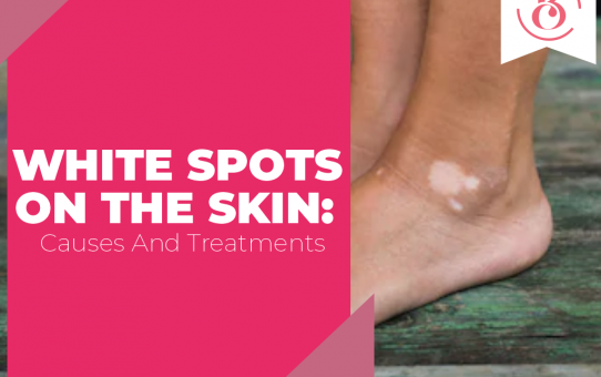 White Spots on The Skin: Causes and Treatments