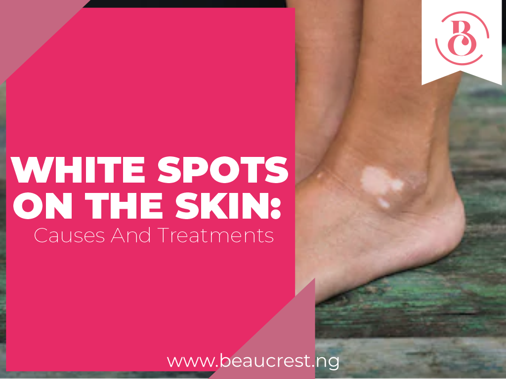 White Spots on The Skin: Causes and Treatments