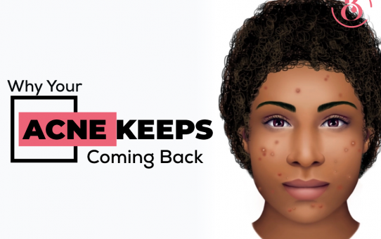 Why Your Acne Keeps Coming Back