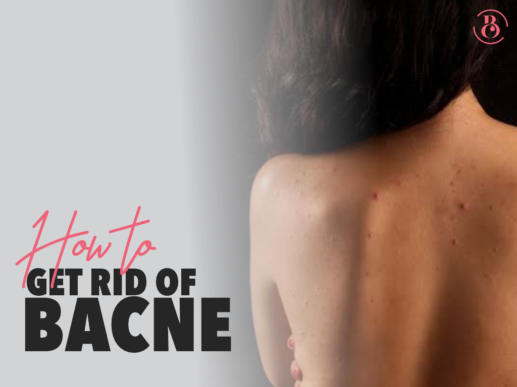 How to Get Rid of Bacne