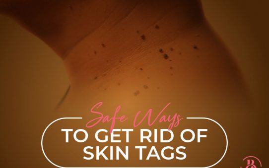5 Safe Ways to Get Rid of Skin Tags