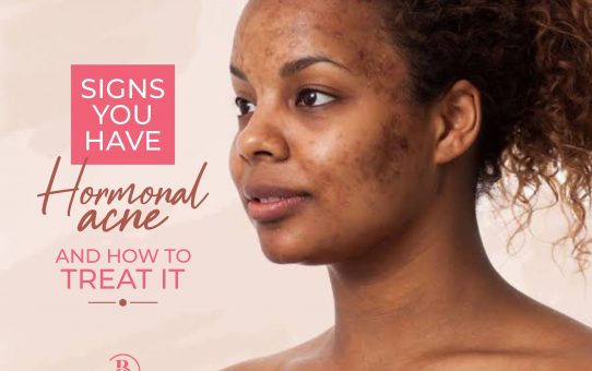 4 Signs You Have Hormonal Acne and How to Treat It