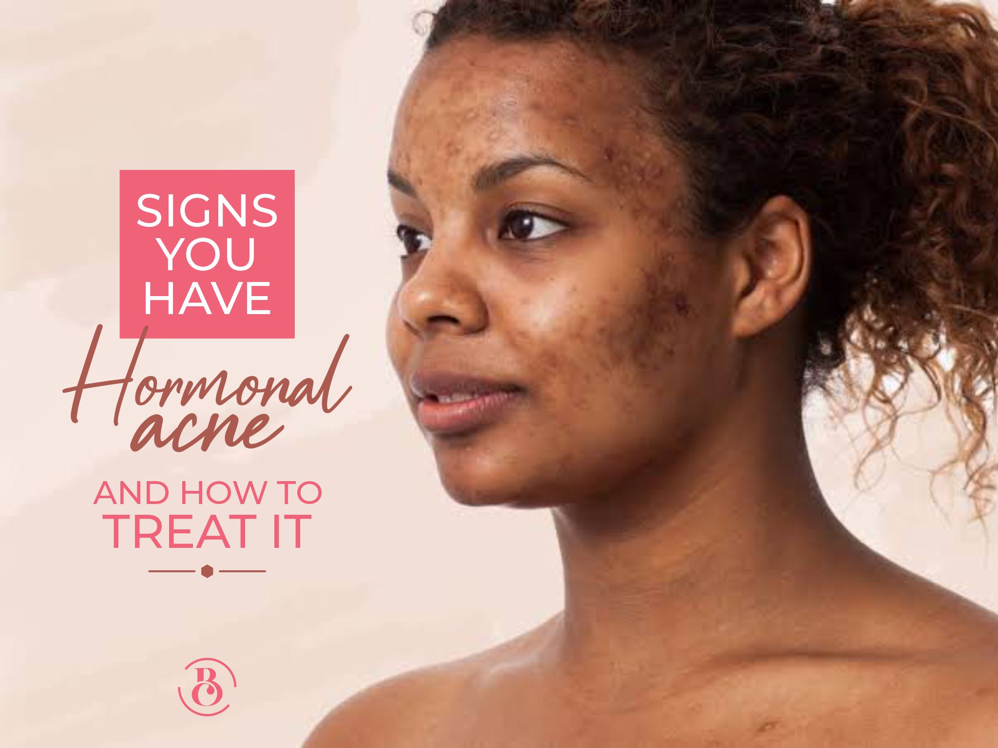 4 Signs You Have Hormonal Acne and How to Treat It