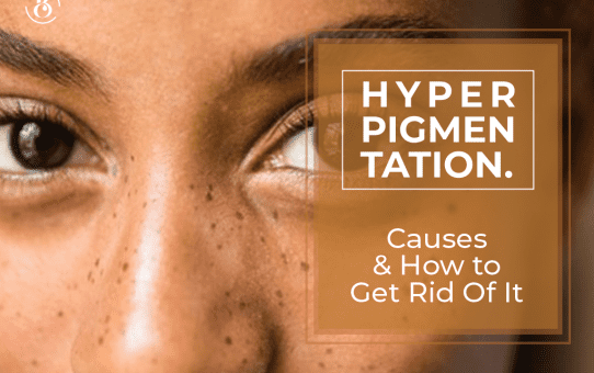 Hyperpigmentation: Causes and How to Get Rid Of It