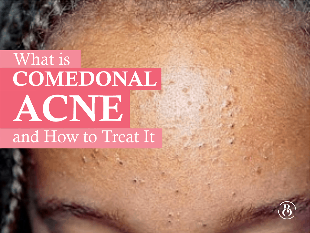 What is Comedonal Acne and how to treat it