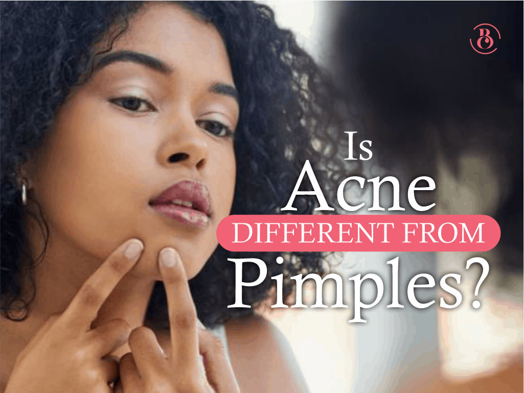 Is Acne Different from Pimples?