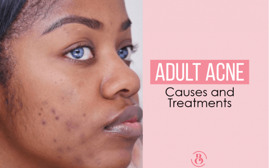Adult Acne: Causes and Treatments