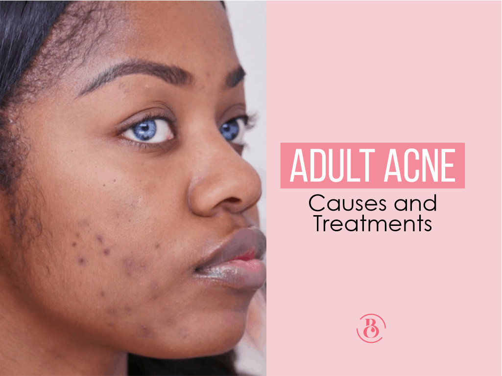 Adult Acne: Causes and Treatments