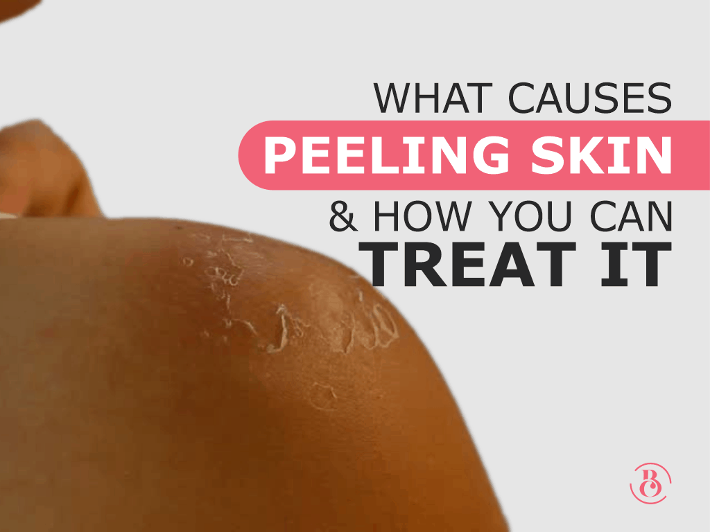 What Causes Peeling Skin and How You Can Treat It