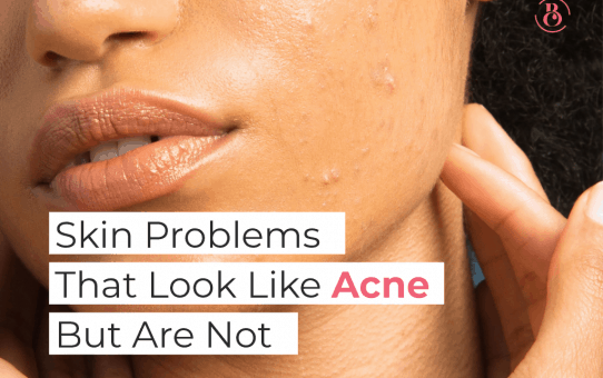 6 Skin Problems That Look Like Acne But Are Not