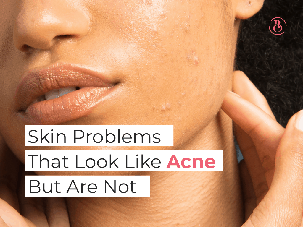 6 Skin Problems That Look Like Acne But Are Not