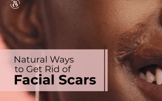 4 Natural Ways to Get Rid of Facial Scars