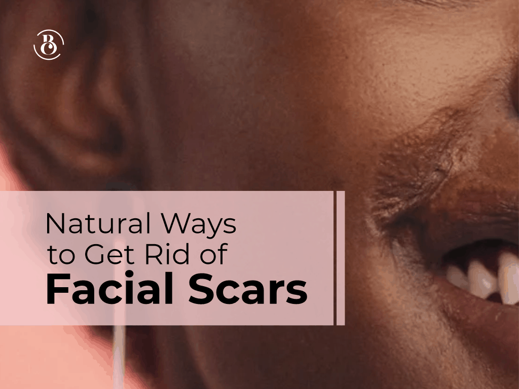 4 Natural Ways to Get Rid of Facial Scars