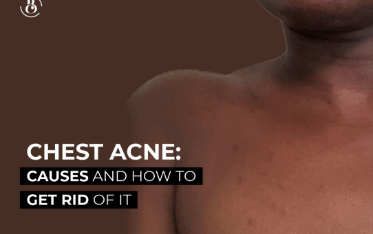 Chest Acne: Causes and How to Get Rid of It