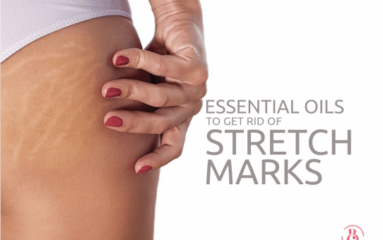 8 Essential Oils to Get Rid of Stretch Marks